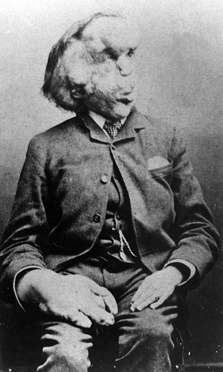 Joseph Merrick 1889